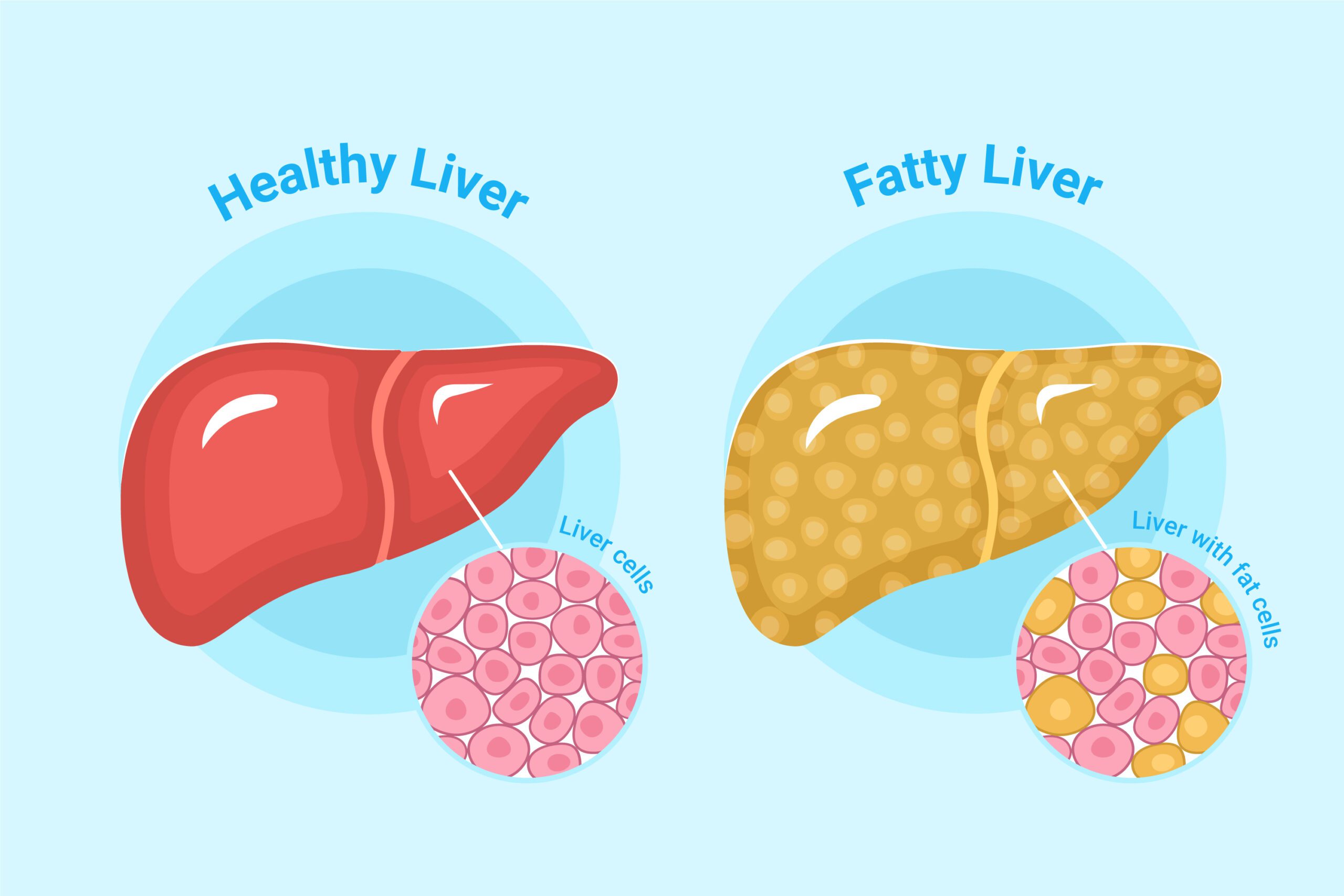 fatty-liver-credit-to-freepik